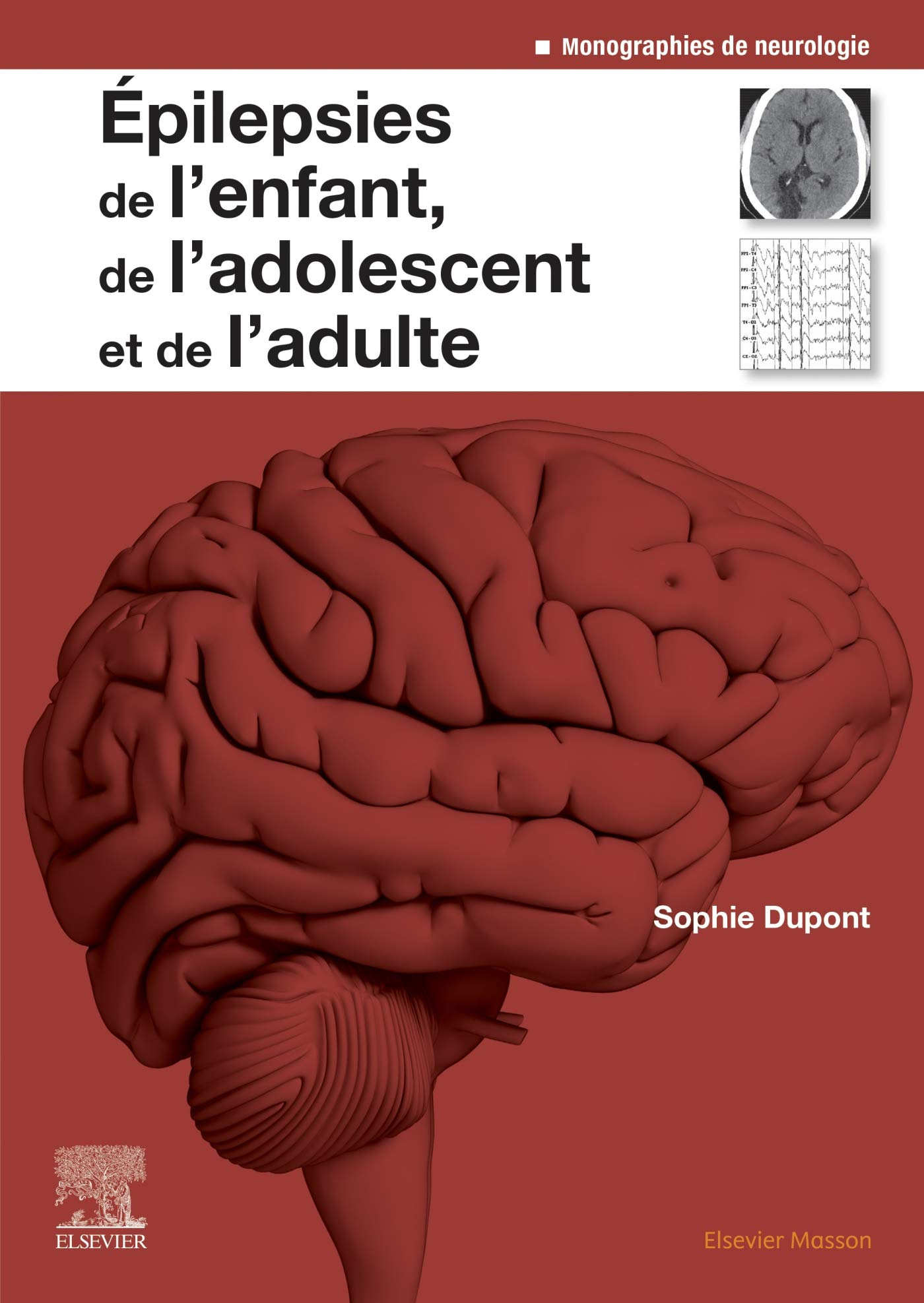 Epilepsies de l'enfant, de l'adolescent et de l'adulte : de la physiopathologie à la prise en charge