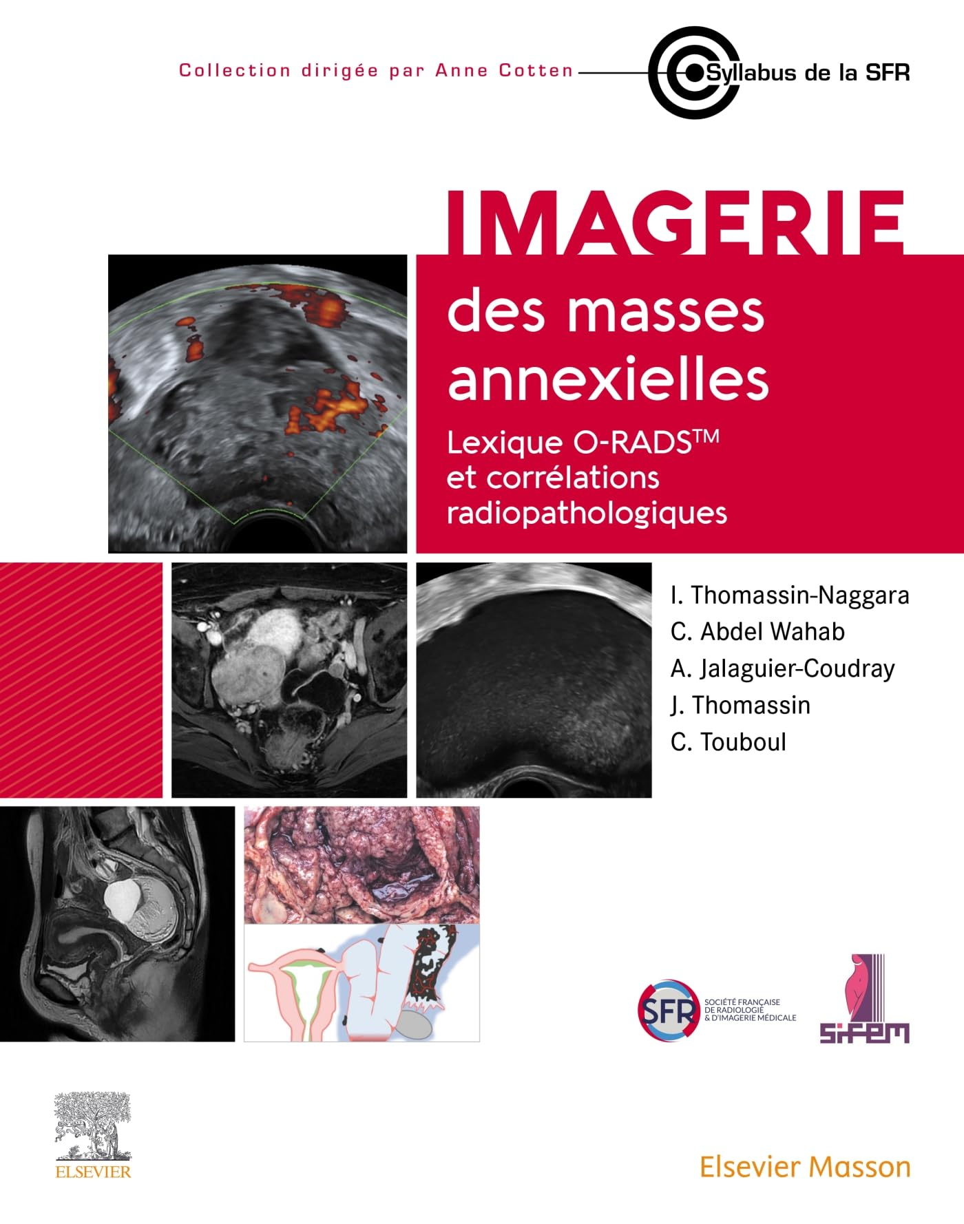 Imagerie des masses annexielles : lexique O-RADS et corrélations radiopathologiques