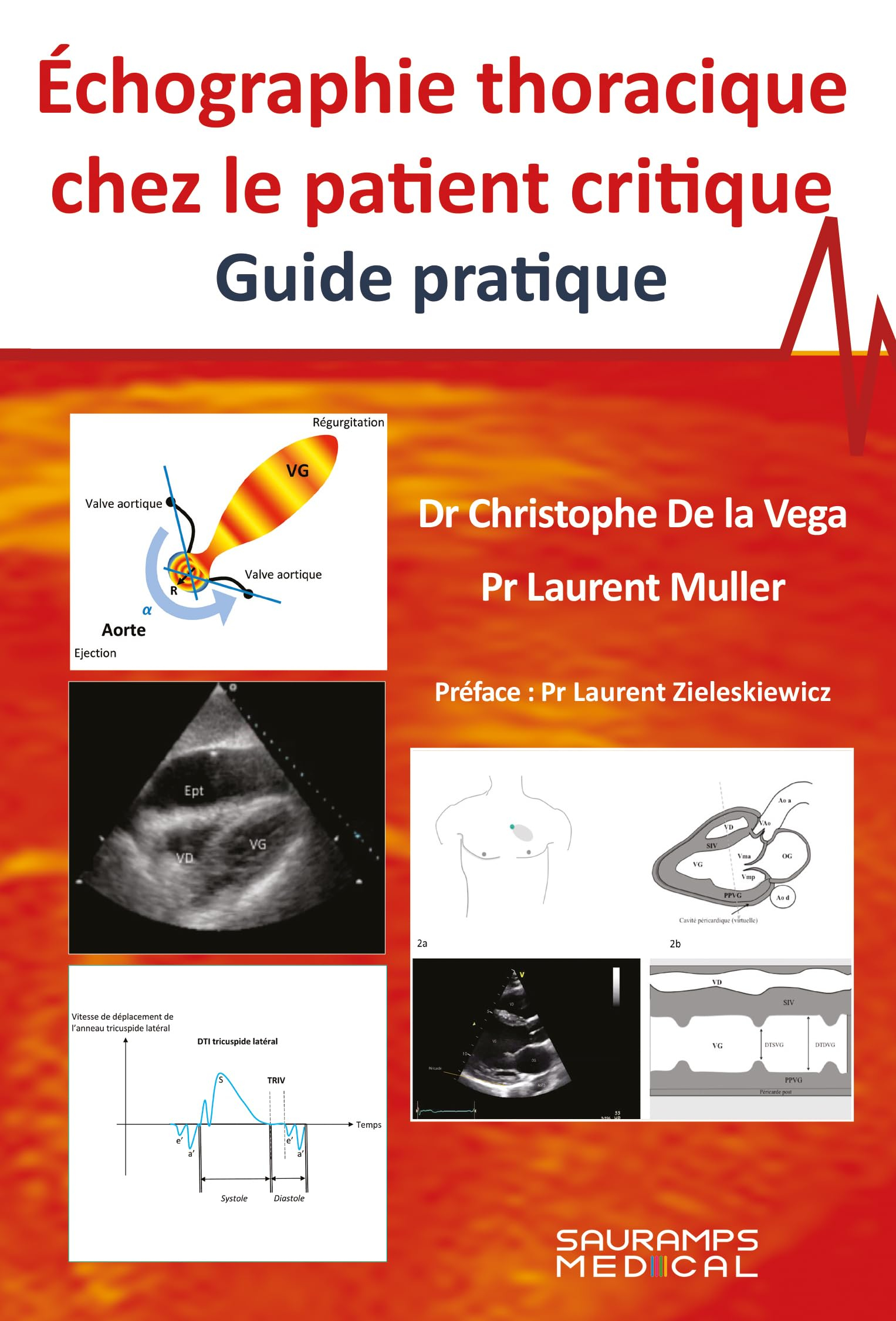 Echographie thoracique chez le patient critique : guide pratique