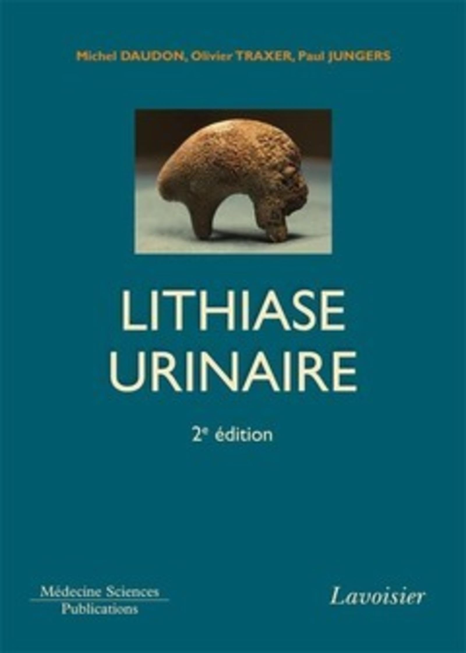 La lithiase urinaire